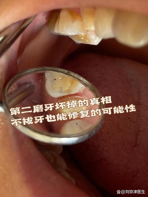 拔了第二磨牙后不种牙,邻牙会松动吗?咀嚼功能受影响怎么办?有哪些替代修复方案需要注意?-图1 拔了第二磨牙后不种牙,邻牙会松动吗?咀嚼功能受影响怎么办?有哪些替代修复方案需要注意?-图1