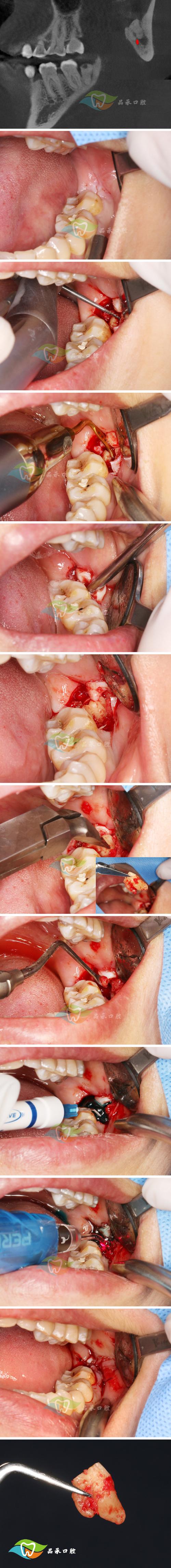 拔了第二磨牙后不种牙,邻牙会松动吗?咀嚼功能受影响怎么办?有哪些替代修复方案需要注意?-图2 拔了第二磨牙后不种牙,邻牙会松动吗?咀嚼功能受影响怎么办?有哪些替代修复方案需要注意?-图2