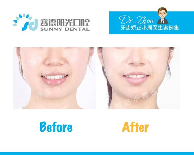 北大口腔正畸博士深度解析，正畸方案如何个性化定制？不同错颌畸形的关键矫正点是什么？-图2