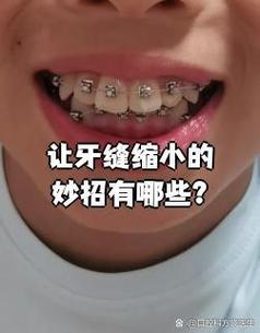 正畸可以让牙缝变小吗-图3 正畸可以让牙缝变小吗-图3