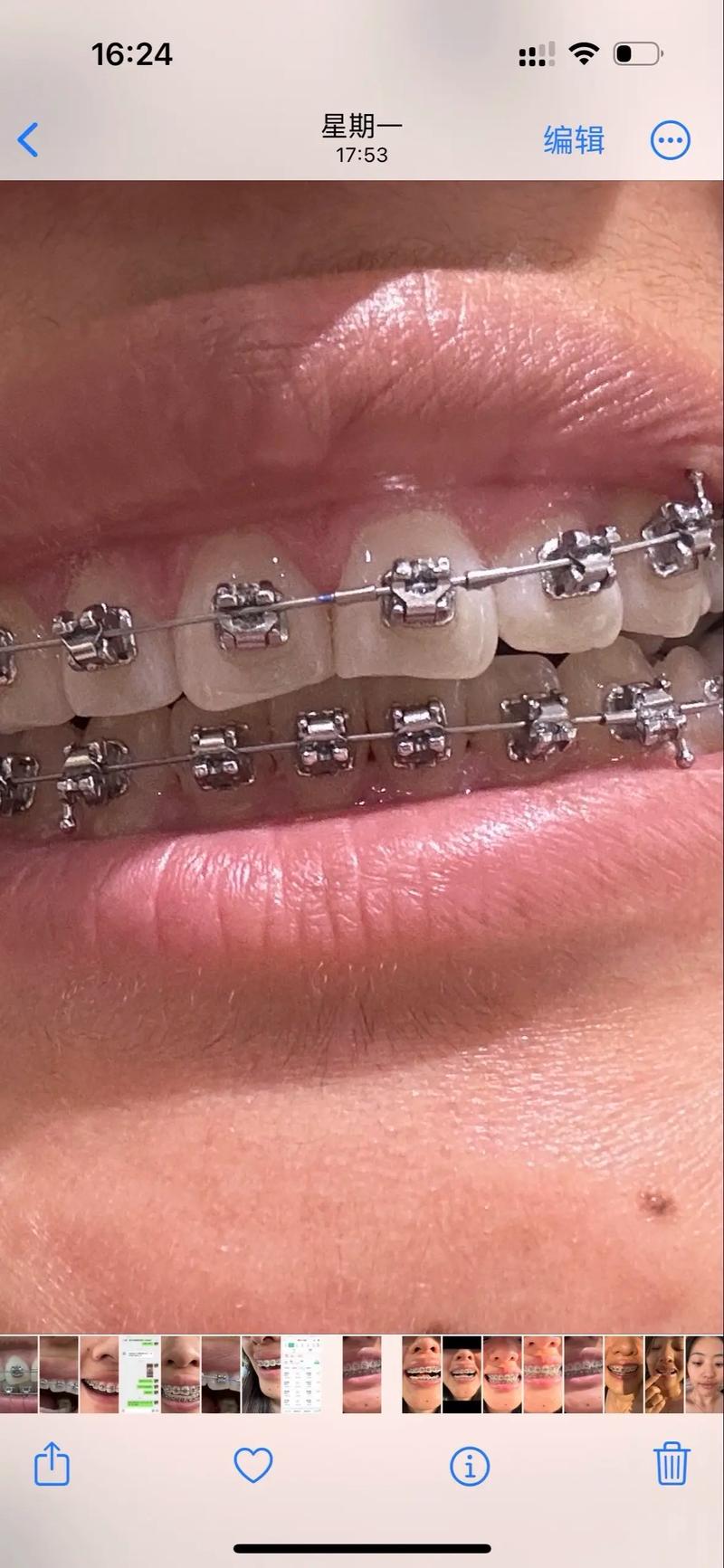 30岁开始正畸，真的有必要吗？时间成本、效果预期和社交影响，该如何权衡？-图1