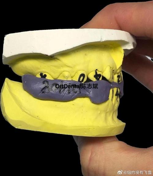 口腔正畸中FR功能调节器如何分类?不同类型的分类依据及临床适用病例有哪些?-图2 口腔正畸中FR功能调节器如何分类?不同类型的分类依据及临床适用病例有哪些?-图2