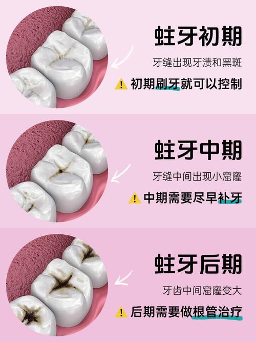 蛀牙最好的治疗方法究竟是什么?不同阶段的蛀牙(如浅龋、深龋)是否需要针对性方案?家庭护理能否替代专业治疗?-图2 蛀牙最好的治疗方法究竟是什么?不同阶段的蛀牙(如浅龋、深龋)是否需要针对性方案?家庭护理能否替代专业治疗?-图2