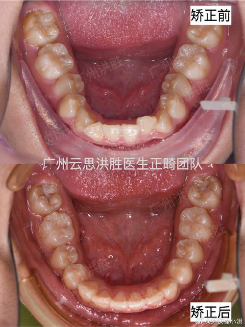 牙齿错位正畸一定要拔牙吗？不拔牙也能矫正吗？拔牙对牙齿功能和脸型会有什么影响？-图2