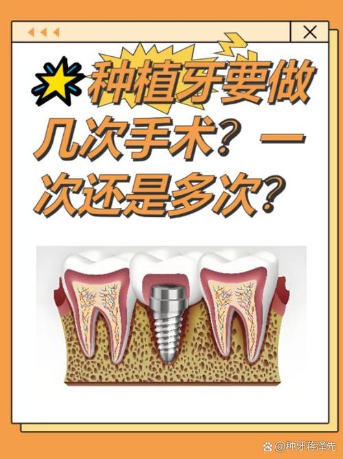 种牙手术时长究竟因哪些因素而异?单颗、多颗或复杂手术分别需要多久?-图2 种牙手术时长究竟因哪些因素而异?单颗、多颗或复杂手术分别需要多久?-图2