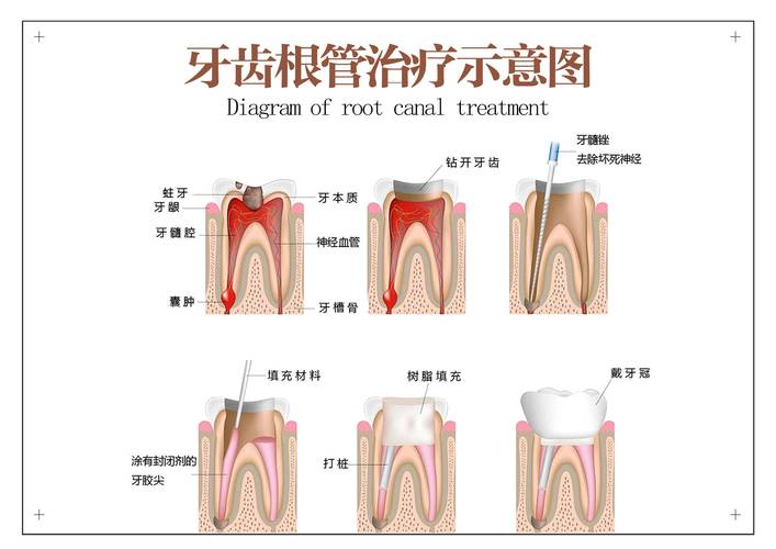 根尖周炎的治疗方法有哪些？不同治疗方式的适用情况、疗效及如何选择最适合自己的方案？-图1