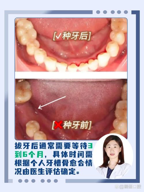 正畸拔牙后牙缝到底多久能完全闭合?受哪些因素影响,不同个体时间差异大吗?-图3 正畸拔牙后牙缝到底多久能完全闭合?受哪些因素影响,不同个体时间差异大吗?-图3