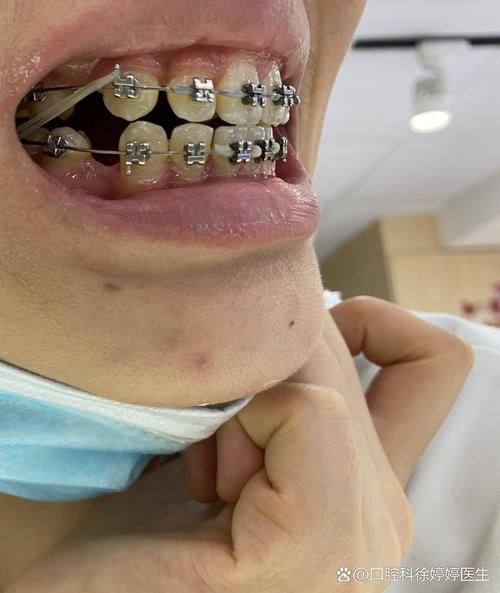 拔牙正畸后牙缝究竟能不能完全闭合？影响因素有哪些，闭合效果如何？-图2