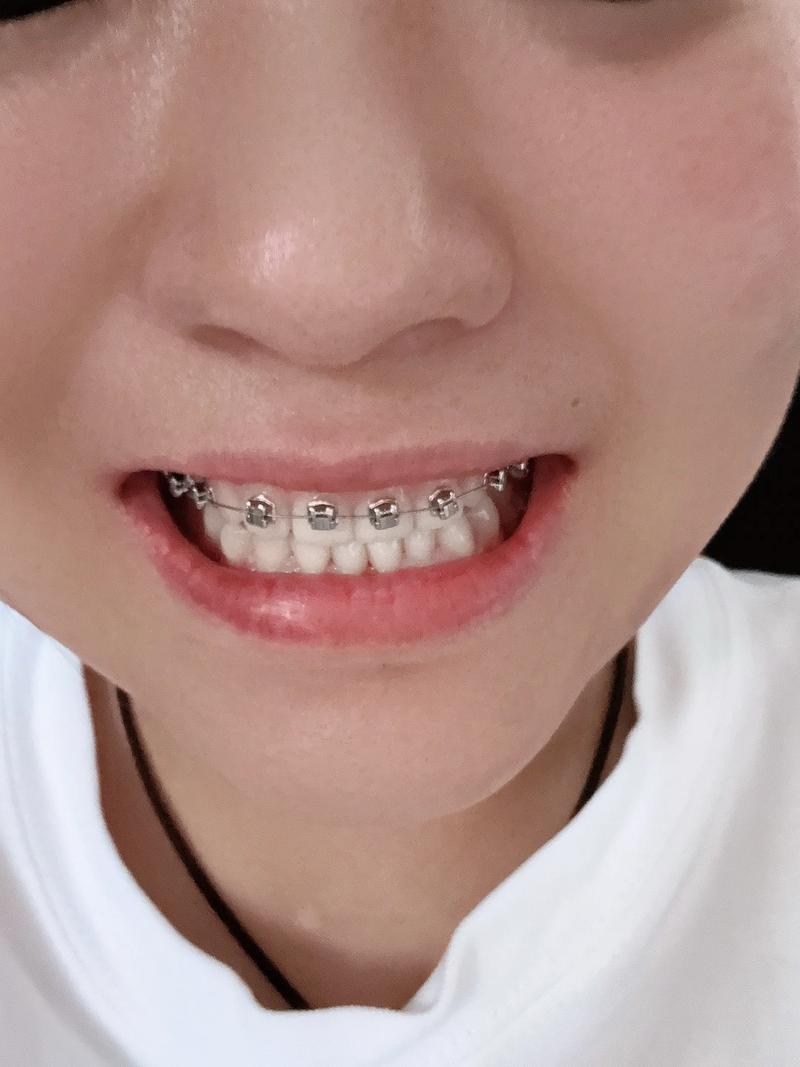 正畸牙齿矫正过程图片能清晰展示哪些阶段的变化？矫正中需注意哪些细节？-图2