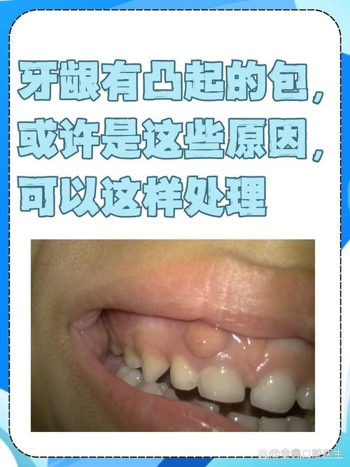 正畸牙齿矫正为何会引发牙龈增生？背后原因、影响及应对方法有哪些？-图1