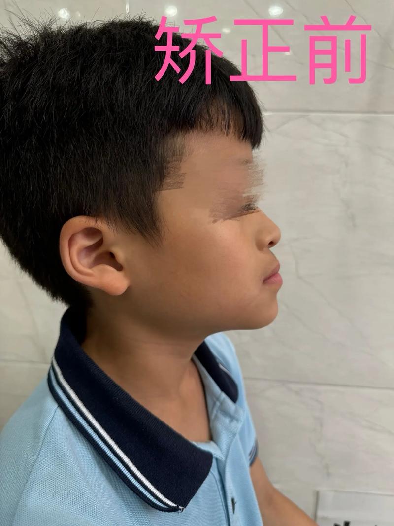 正畸富士0去除的正确方法是什么？操作时需注意哪些事项以避免牙齿损伤？-图3