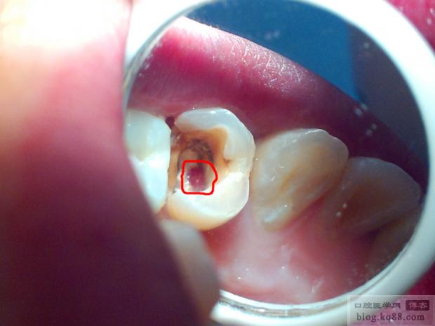 根管侧穿后如何科学补救？不同补救方法的适用场景与成功率解析-图1