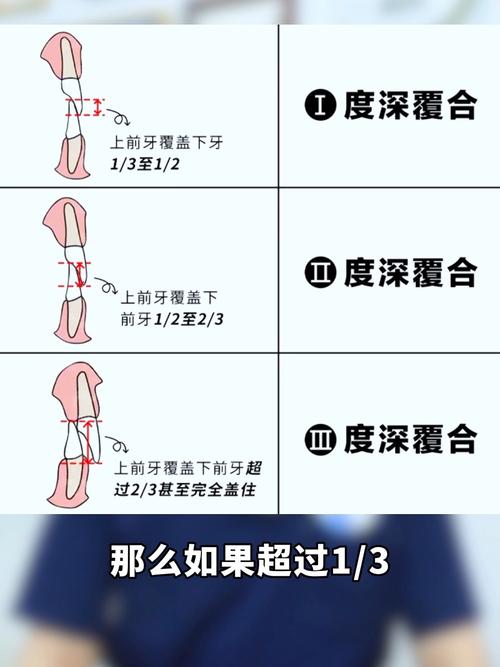 深覆合能否通过自我矫正有效改善？具体方法有哪些科学依据及风险需警惕？-图3