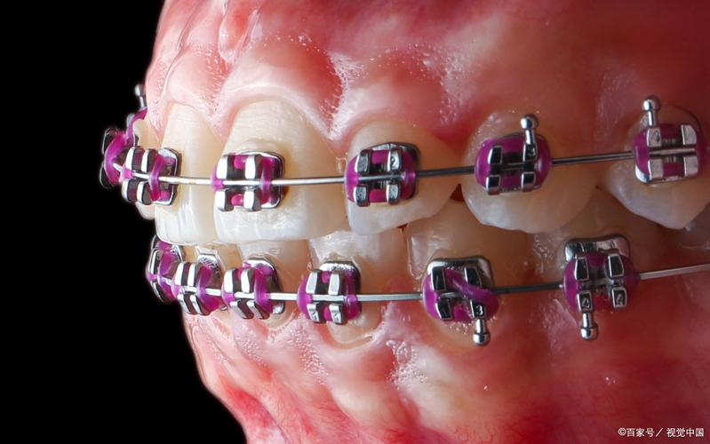 正畸过程中牙齿真的会脱落吗？脱落风险有多大，哪些因素可能导致？-图2