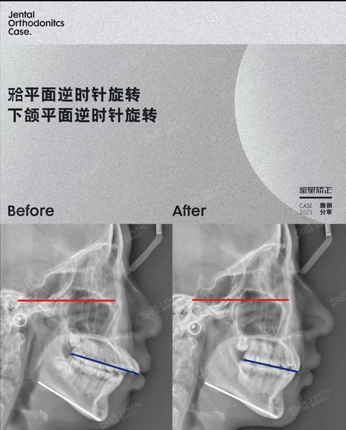正畸头颅侧位定点软件如何通过精准定位提升错颌畸形诊断效率与方案个性化？-图2