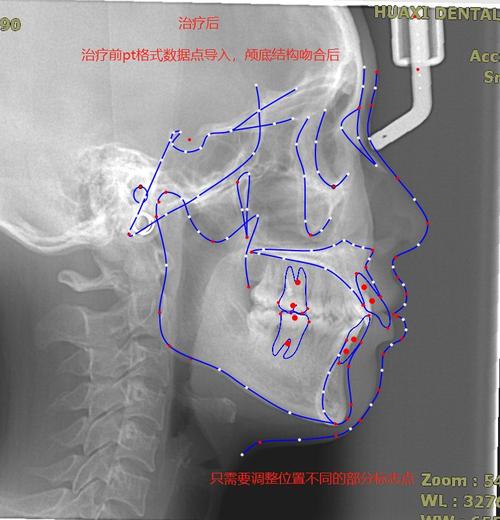 正畸头颅侧位定点软件如何通过精准定位提升错颌畸形诊断效率与方案个性化？-图1