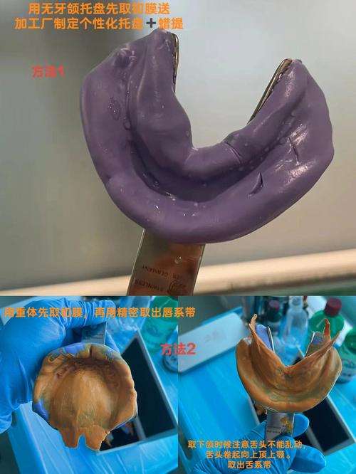 在精密附件修复中,如何选择合适的取模方法以确保印模精度和边缘适合性?-图1 在精密附件修复中,如何选择合适的取模方法以确保印模精度和边缘适合性?-图1