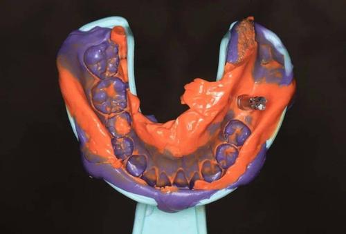 在精密附件修复中，如何选择合适的取模方法以确保印模精度和边缘适合性？-图2