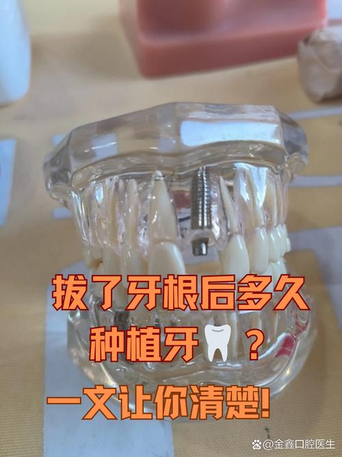 拔完牙后究竟要等多久才能种牙？不同愈合阶段的时间差异和影响种植时机的关键因素有哪些？-图1
