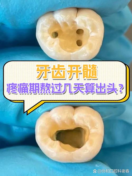 牙髓充血的正确处理方法有哪些？不同病因和症状阶段的治疗方案与注意事项有何差异？-图2