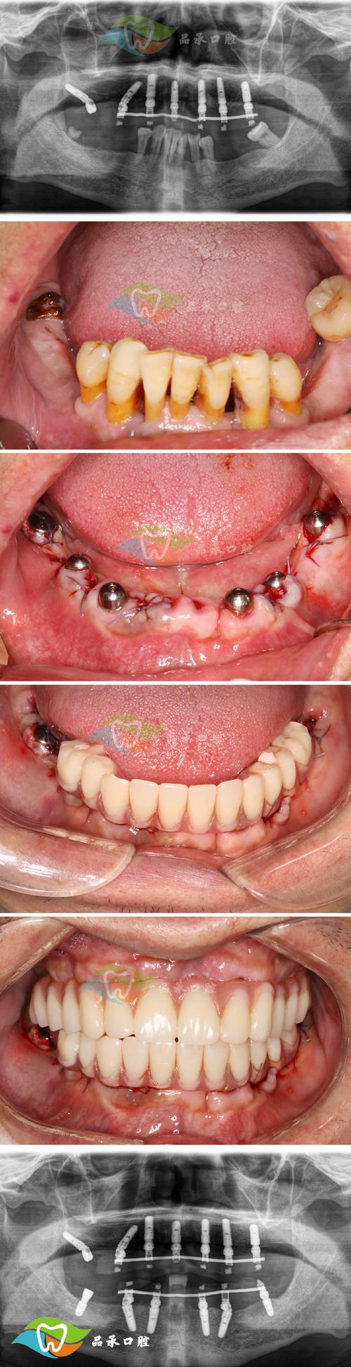 正畸微种植钉植入视频适合哪些口腔医生学习？能否通过视频掌握植入角度、深度等关键操作要点？-图3