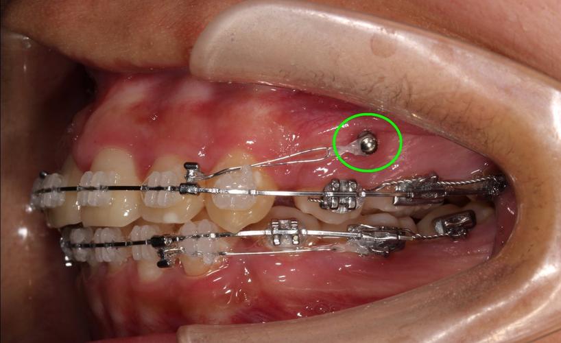 正畸微种植钉植入视频适合哪些口腔医生学习？能否通过视频掌握植入角度、深度等关键操作要点？-图1