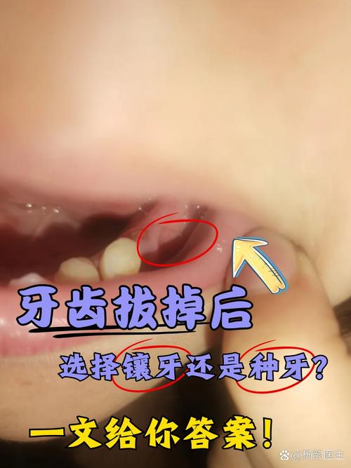拔牙后一定要种牙吗？除了种牙还有哪些修复方式？什么情况下需要优先考虑种牙，什么情况可以不种？-图2