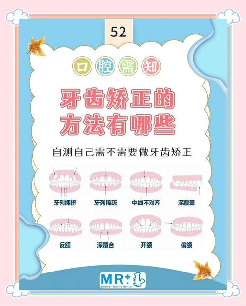 牙齿整形有几种常见方法?不同方法分别适合哪些牙齿问题?效果和优缺点如何?-图3 牙齿整形有几种常见方法?不同方法分别适合哪些牙齿问题?效果和优缺点如何?-图3