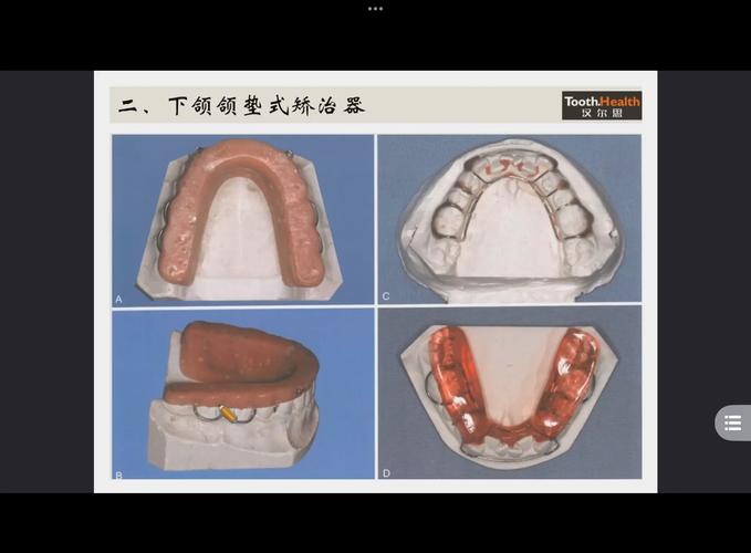 正畸托槽安置器怎么用？新手必看的使用步骤与注意事项详解-图1