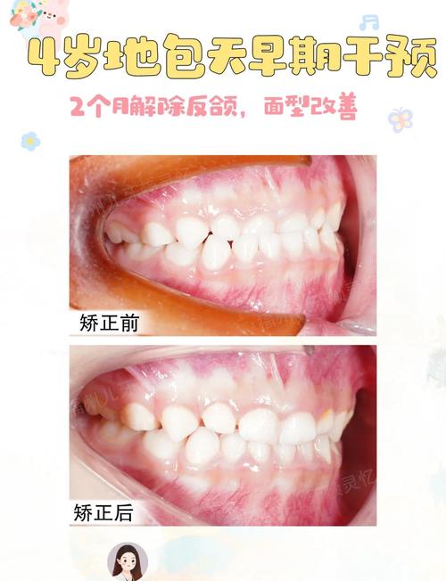 正畸治疗地包天具体有哪些方法？效果如何？有没有年龄限制？一般需要多长时间？-图2