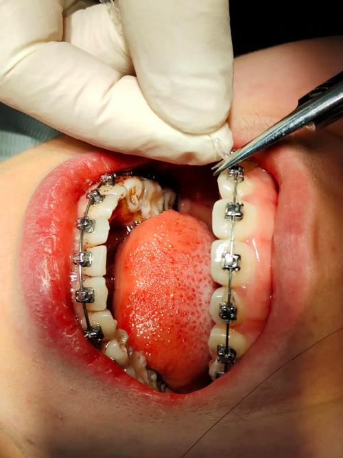 正畸治疗地包天具体有哪些方法？效果如何？有没有年龄限制？一般需要多长时间？-图1