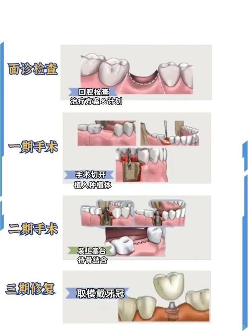 种植牙修复是否真的需要整整一年时间？不同牙槽骨条件、是否植骨会影响种牙周期吗？-图2