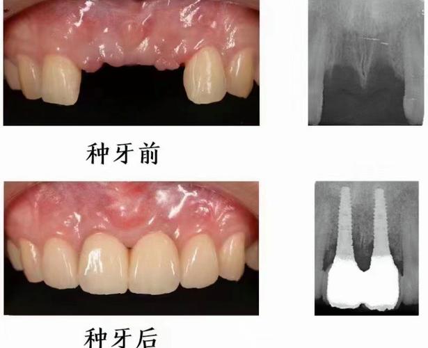 东四口腔医院种牙效果真的好吗？医生团队是否专业？价格透明吗？术后护理有保障吗？-图3