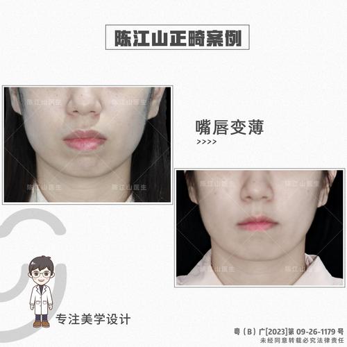 牙槽骨突出矫正方法有哪些？不同年龄段患者如何选择最适合自己的治疗方案？-图2