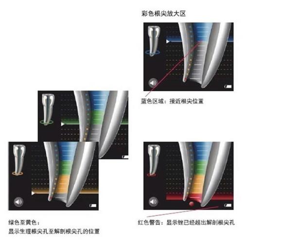 根管测量仪的正确使用方法包含哪些关键步骤?操作中如何避免常见误差确保测量精准?-图1 根管测量仪的正确使用方法包含哪些关键步骤?操作中如何避免常见误差确保测量精准?-图1