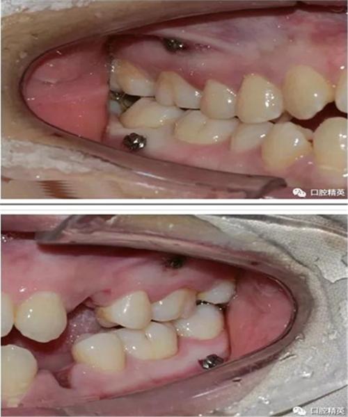 正畸微种植钉植入图片中,操作步骤、解剖结构识别与关键技术要点如何通过影像呈现?-图1 正畸微种植钉植入图片中,操作步骤、解剖结构识别与关键技术要点如何通过影像呈现?-图1