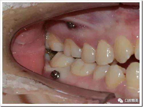 正畸微种植钉植入图片中,操作步骤、解剖结构识别与关键技术要点如何通过影像呈现?-图2 正畸微种植钉植入图片中,操作步骤、解剖结构识别与关键技术要点如何通过影像呈现?-图2