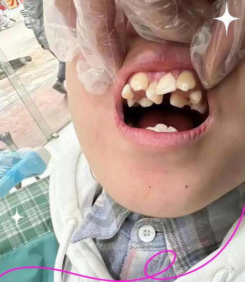 虎牙矫正的最好方法是什么？不同牙齿畸形程度如何选择最优矫正方案？-图2