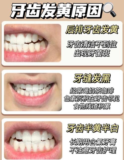 在家美白牙齿的方法真的有效吗？哪些安全又不会损伤牙釉质？-图2