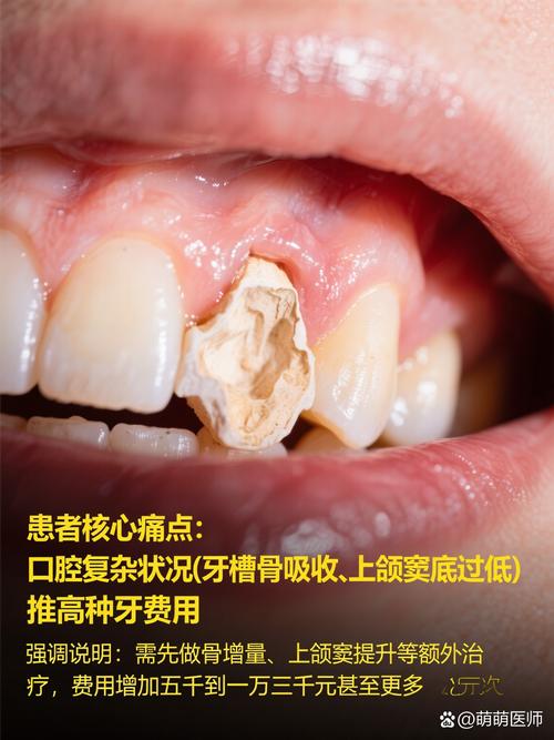 种一颗牙为何动辄上万?价格背后的技术成本与患者负担引热议,到底值不值?-图3 种一颗牙为何动辄上万?价格背后的技术成本与患者负担引热议,到底值不值?-图3