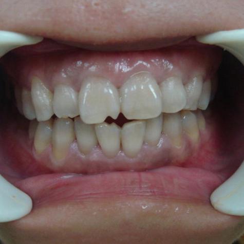 种牙后服用四环素会影响种植体骨结合效果或引发不良反应吗？-图2