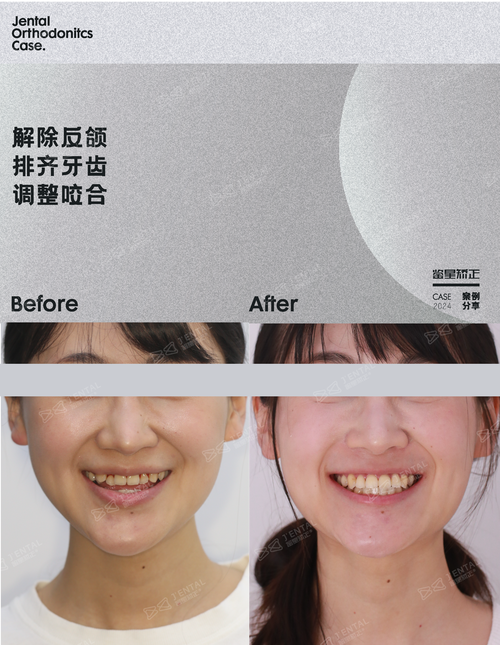日本牙齿正畸为何让普通民众做不起？高昂费用背后藏着哪些技术或制度因素？-图3