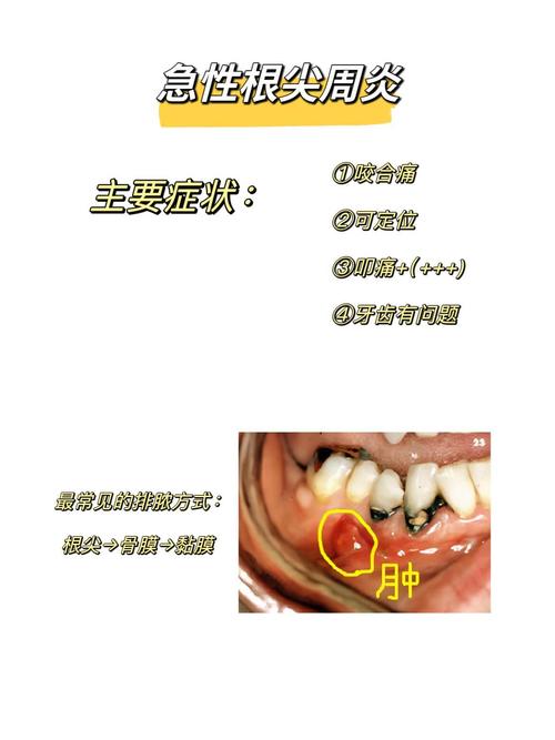 根尖周炎的治疗方法有哪些？急性与慢性阶段的治疗方案有何差异？如何选择最适合自身的治疗方式？-图1