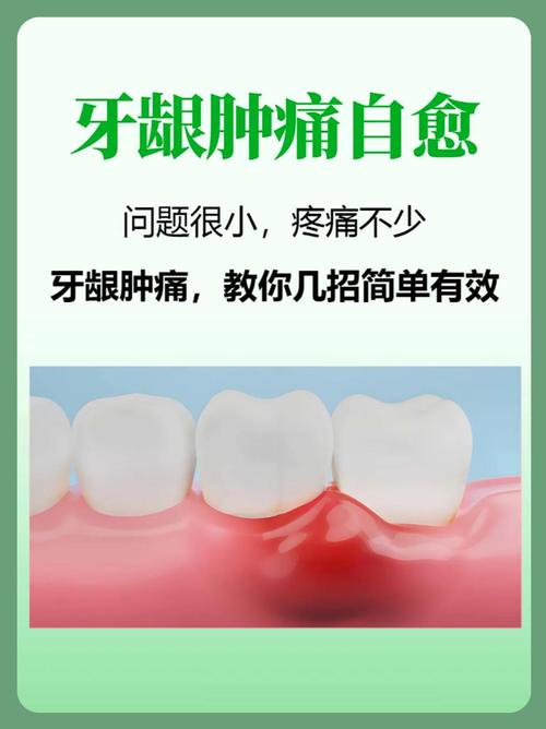 牙龈肿痛时最快消肿方法是什么?真的有立竿见影的妙招吗?多久能见效?有没有副作用?-图1 牙龈肿痛时最快消肿方法是什么?真的有立竿见影的妙招吗?多久能见效?有没有副作用?-图1