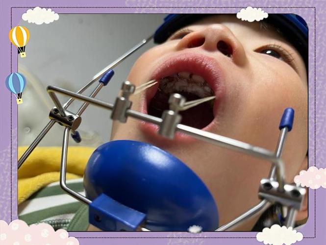 12岁牙齿反合用正畸-图2