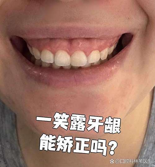 南京牙齿正畸矫正后露牙龈笑是什么原因？如何通过调整方案改善笑容美观问题？-图1