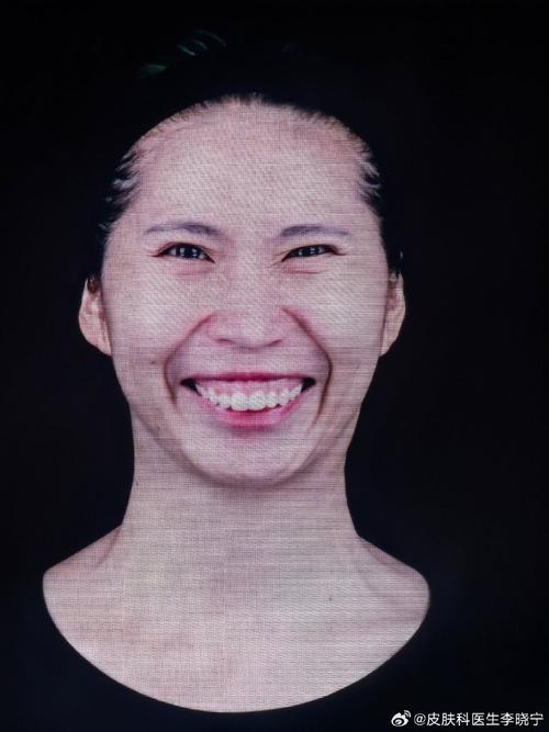 南京牙齿正畸矫正后露牙龈笑是什么原因?如何通过调整方案改善笑容美观问题?-图3 南京牙齿正畸矫正后露牙龈笑是什么原因?如何通过调整方案改善笑容美观问题?-图3