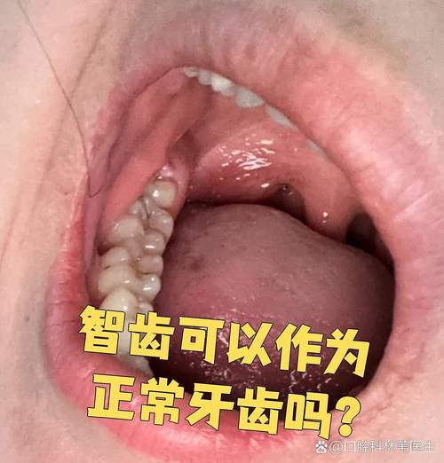 正畸前智齿一定要拔吗?哪些情况下的智齿可以不用拔除?-图2 正畸前智齿一定要拔吗?哪些情况下的智齿可以不用拔除?-图2