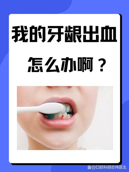 不同原因导致的牙龈出血有哪些有效的治疗方法?日常护理和医疗干预如何结合?-图1 不同原因导致的牙龈出血有哪些有效的治疗方法?日常护理和医疗干预如何结合?-图1