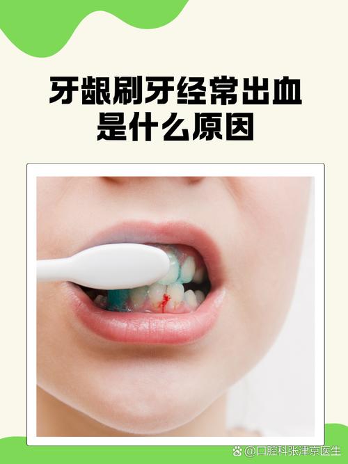 不同原因导致的牙龈出血有哪些有效的治疗方法?日常护理和医疗干预如何结合?-图2 不同原因导致的牙龈出血有哪些有效的治疗方法?日常护理和医疗干预如何结合?-图2